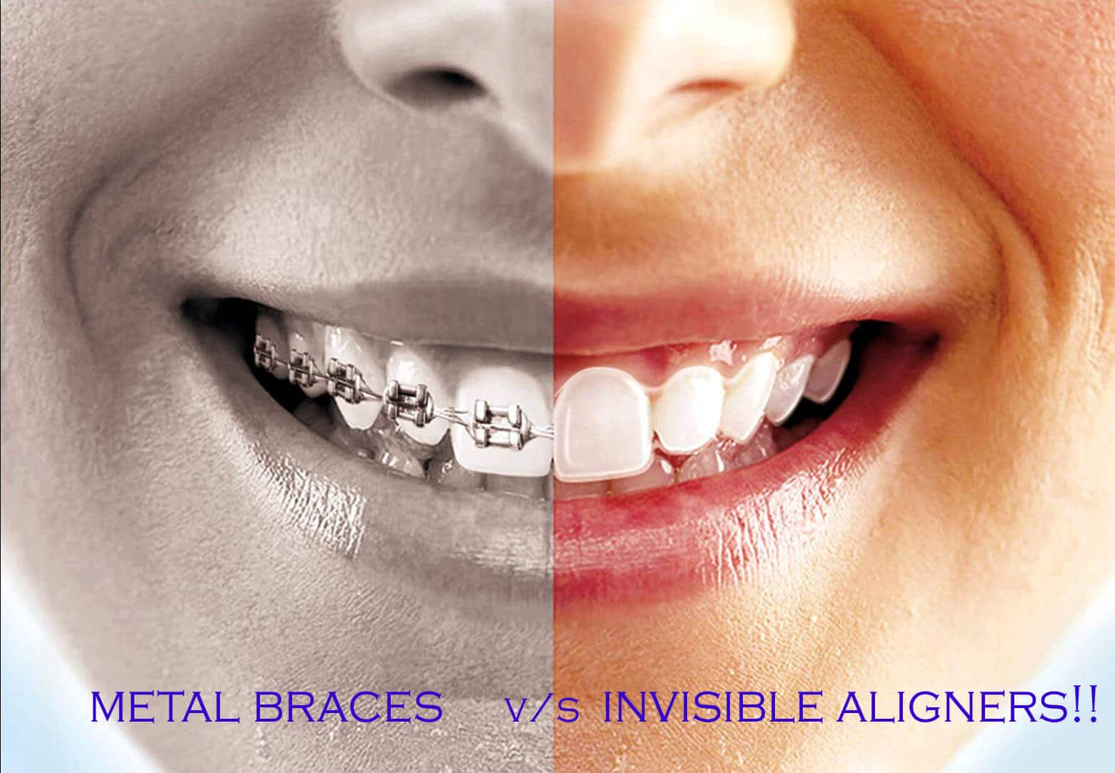Invisible Aligner at Avance Dental