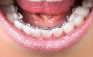 Best Lingual Braces at Avance Dental in Dubai