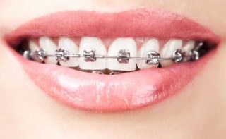 Dental Metal Braces at Avance Dental in Dubai